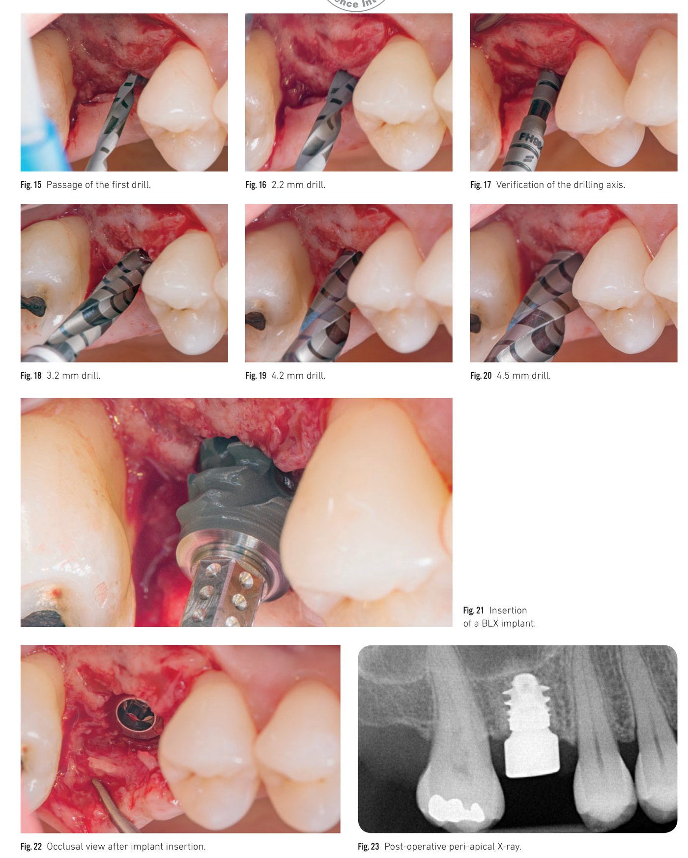 Surgical protocol demonstration: step-by-step from osteotomy preparation to implant seating (Fig 15-23)