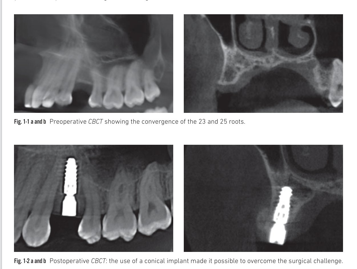 Clinical situation 1: CBCT views showing converging roots and conical implant placement