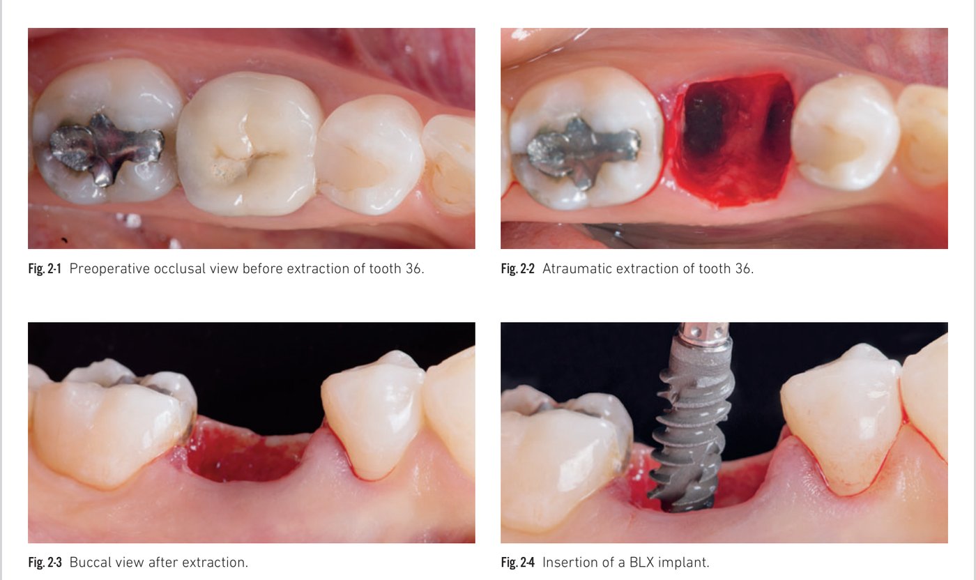 Clinical situation 2, page 1: Preoperative view, atraumatic extraction, and BLX insertion