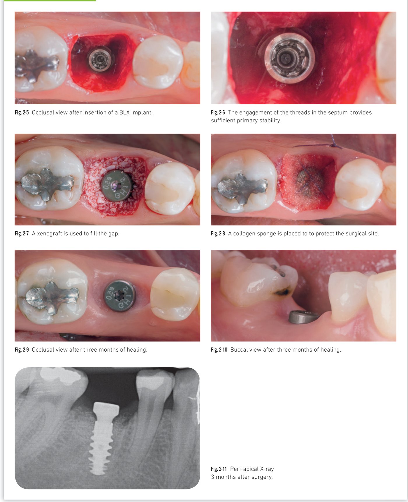 Clinical situation 2, page 2: Xenograft filling, collagen sponge, healing, and peri-apical X-ray