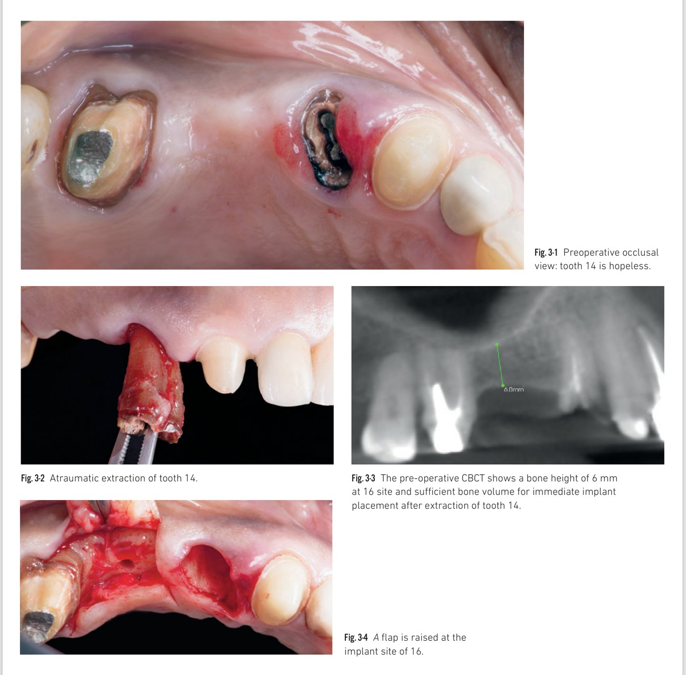 Clinical situation 3, page 1: Preoperative view, extraction, CBCT, and drilling