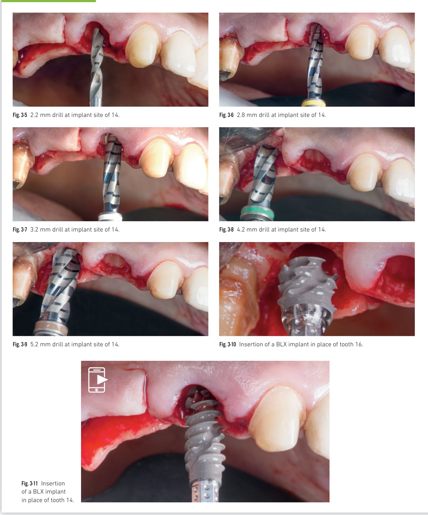 Clinical situation 3, page 2: BLX insertions and immediate provisional bridge