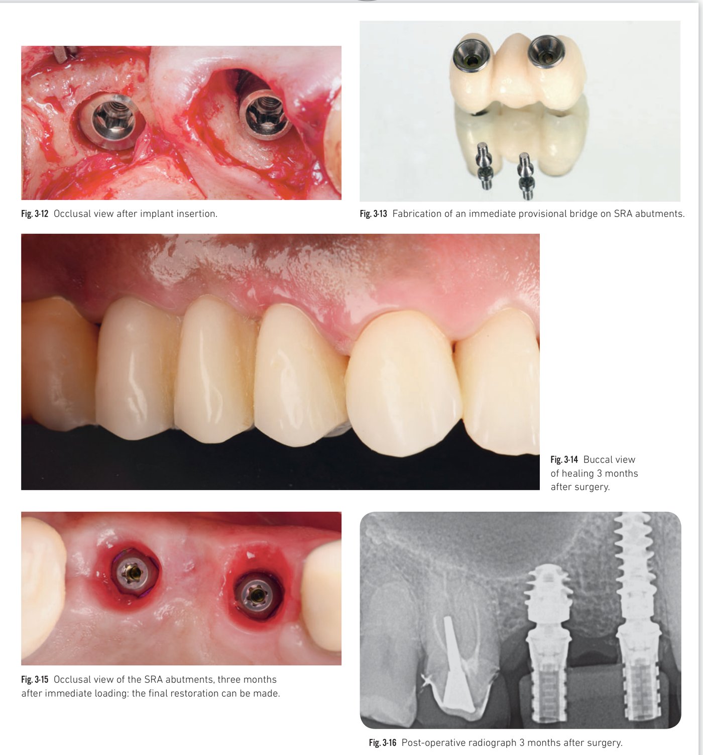 Clinical situation 3, page 3: Healing and post-operative X-ray