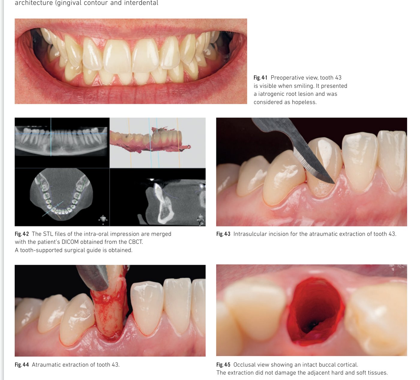 Clinical situation 4, page 1: Surgical guide, extraction, drilling, and BLX insertion