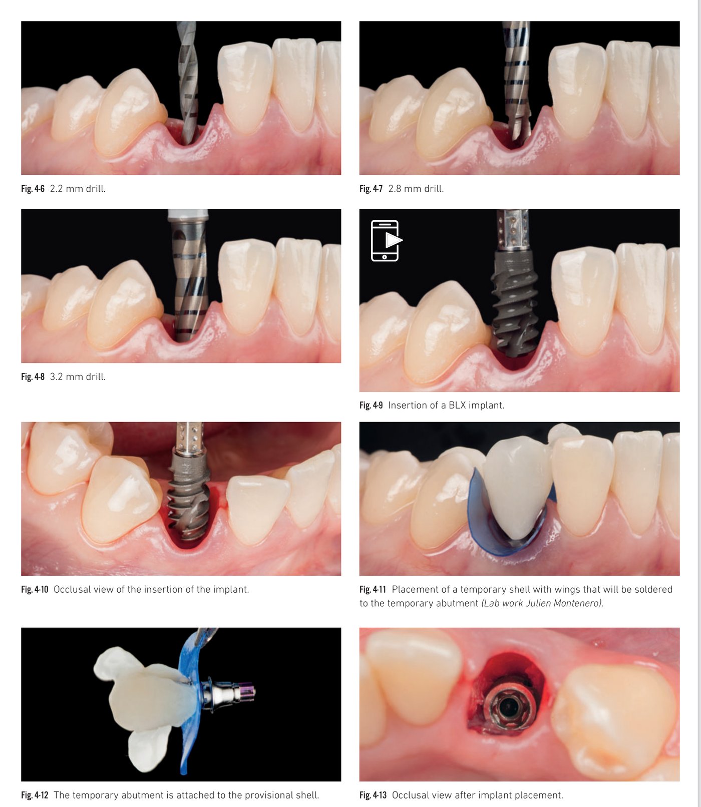 Clinical situation 4, page 2: Temporary shell, dual-zone filling, and healing