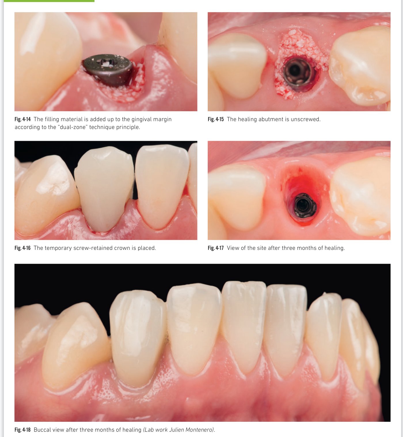 Clinical situation 5, page 1: CBCT, extraction, and BLX placement