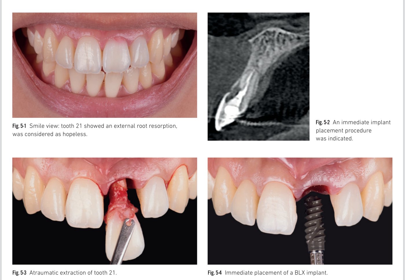 Clinical situation 5, page 2: Temporary abutment and chairside crown fabrication