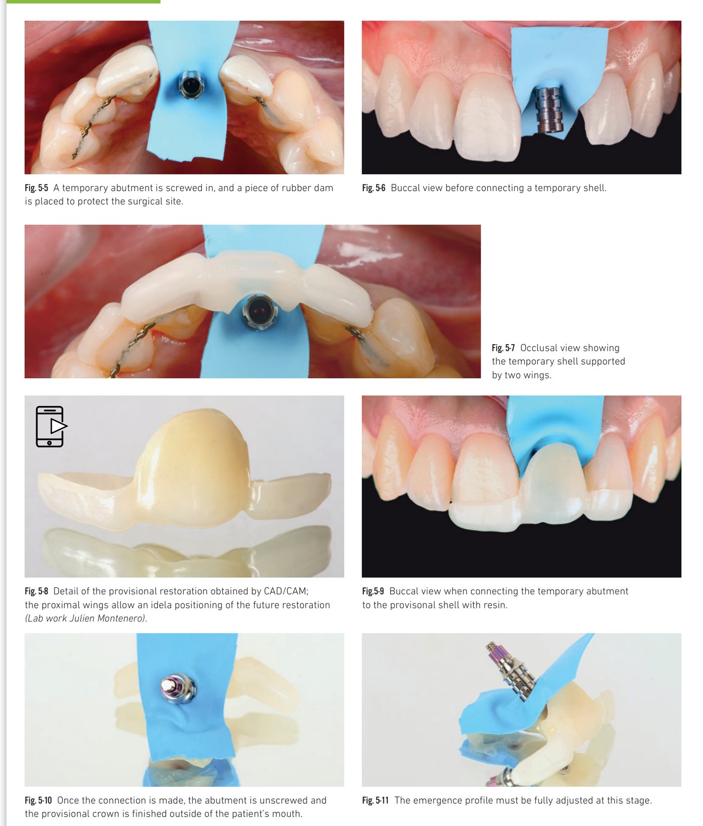 Clinical situation 5, page 3: Emergence profile, healing, and post-operative X-ray