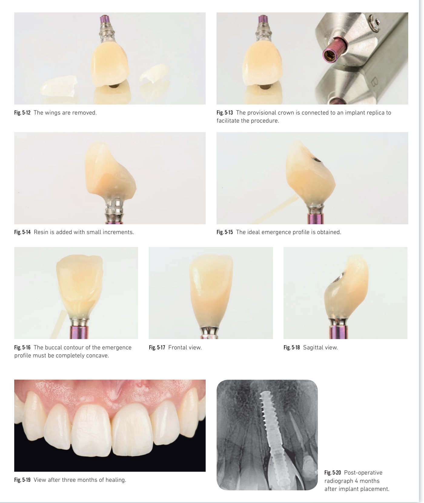 Clinical situation 6, page 1: Intraoral view, extraction, and BLX insertion