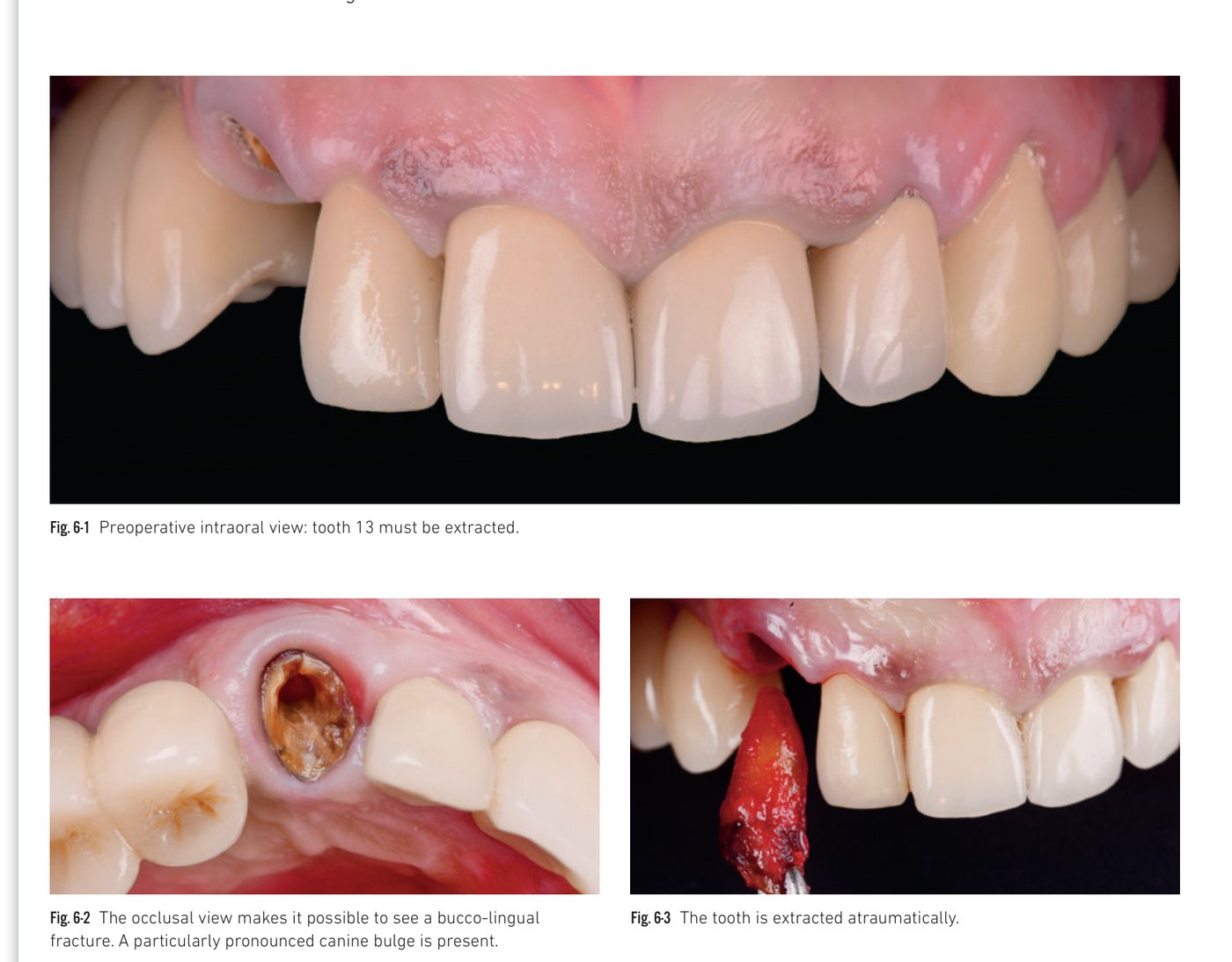 Clinical situation 6, page 2: Temporary shell and connective tissue graft