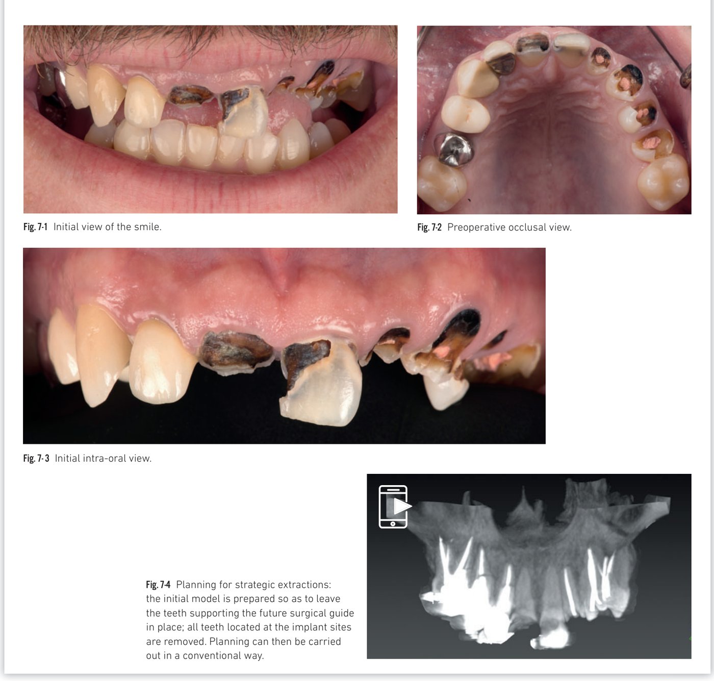 Clinical situation 7, page 2: Guided surgery and BLX insertions
