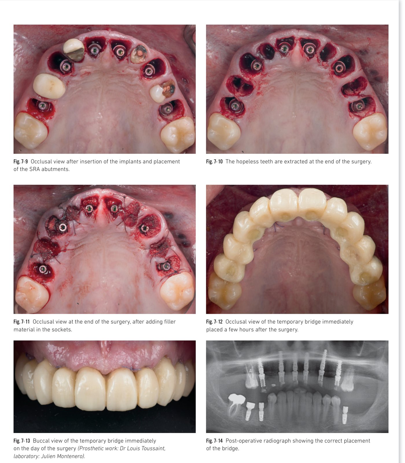 Clinical situation 8, page 1: Initial situation and implant planning