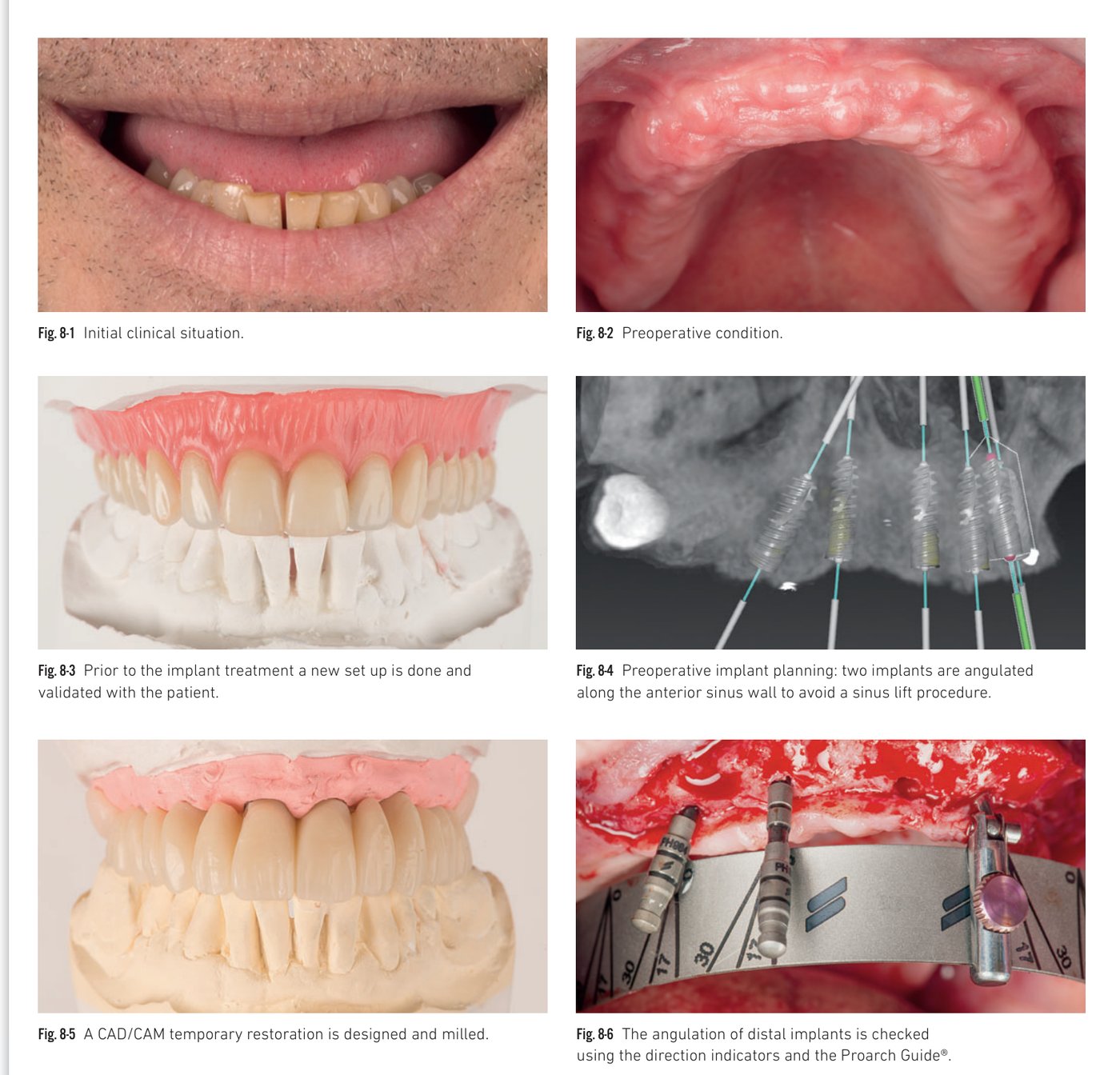 Clinical situation 8, page 2: Osteotomy and BLX placement with SRA abutments