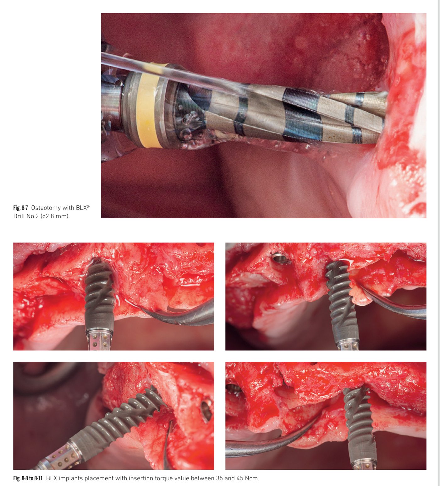 Clinical situation 8, page 3: Impression protocol