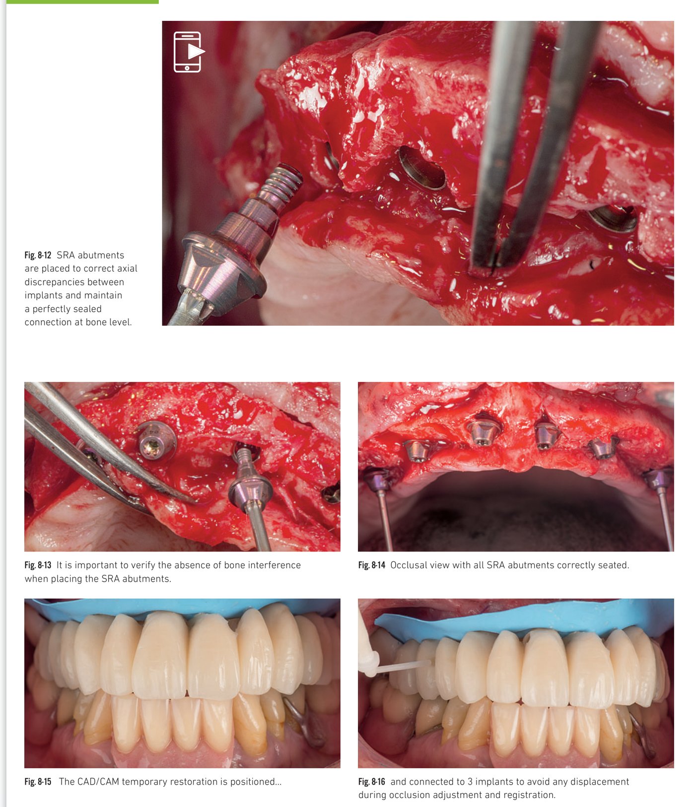 Clinical situation 8, page 4: CAD/CAM restoration fabrication