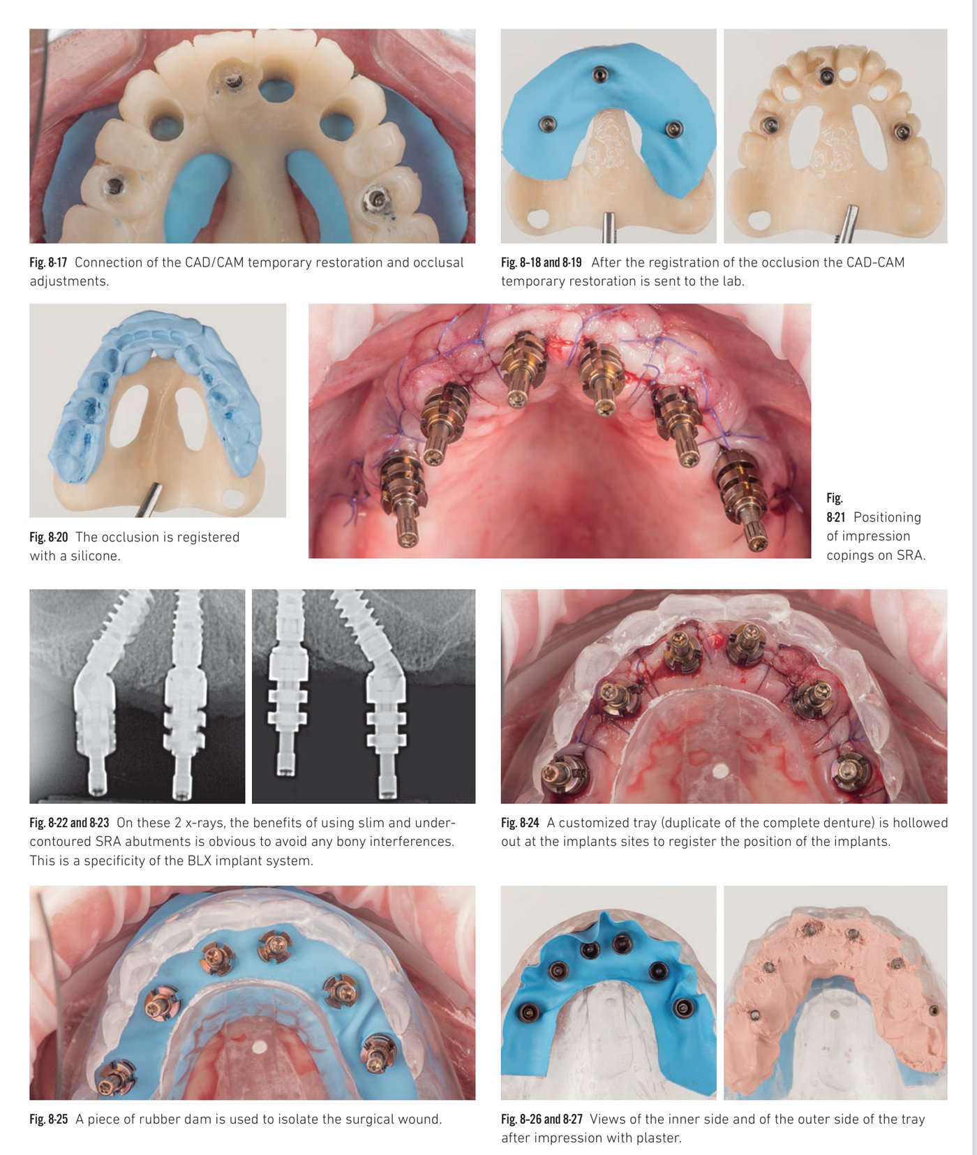 Clinical situation 8, page 5: Emergence profiles and prosthetic fitting