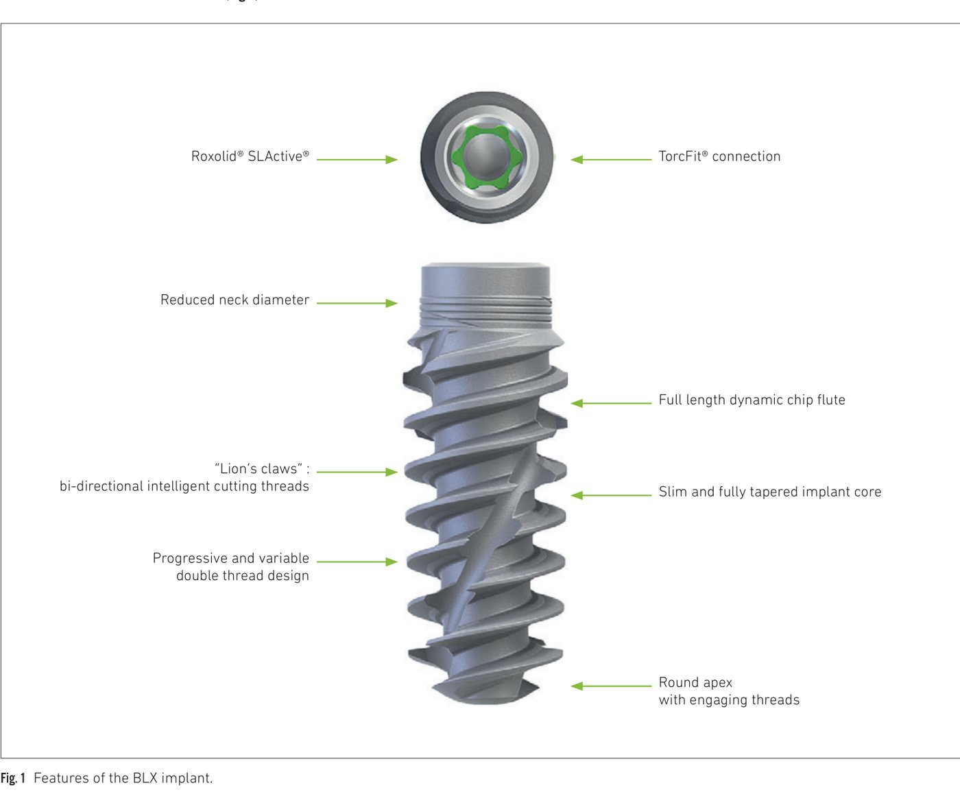Fig 1: Overview of BLX implant features showing full implant architecture with labeled components
