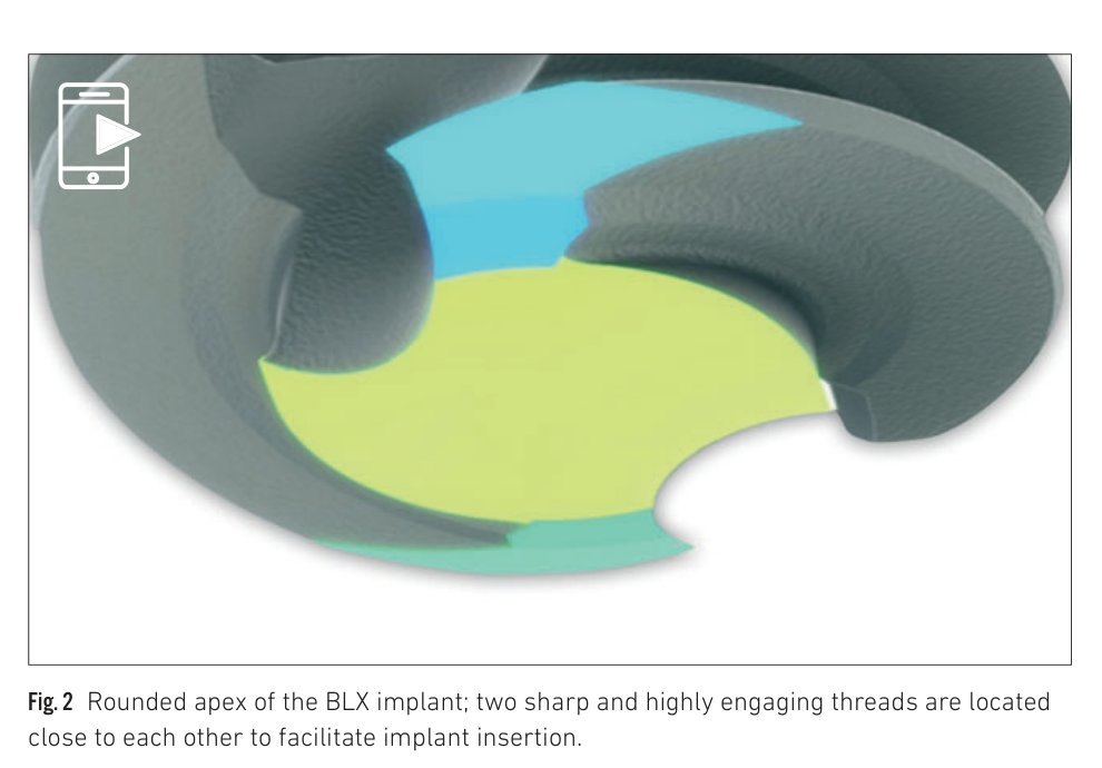 Fig 2: Rounded and softened apex design of the BLX implant