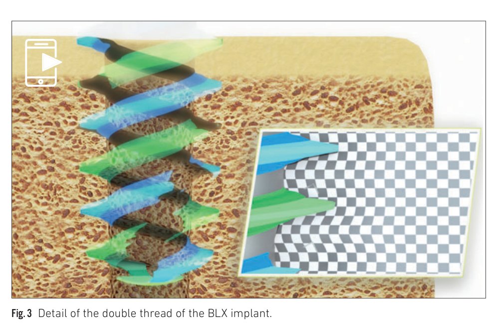 Fig 3: Double thread detail showing variable spacing and width along the implant body