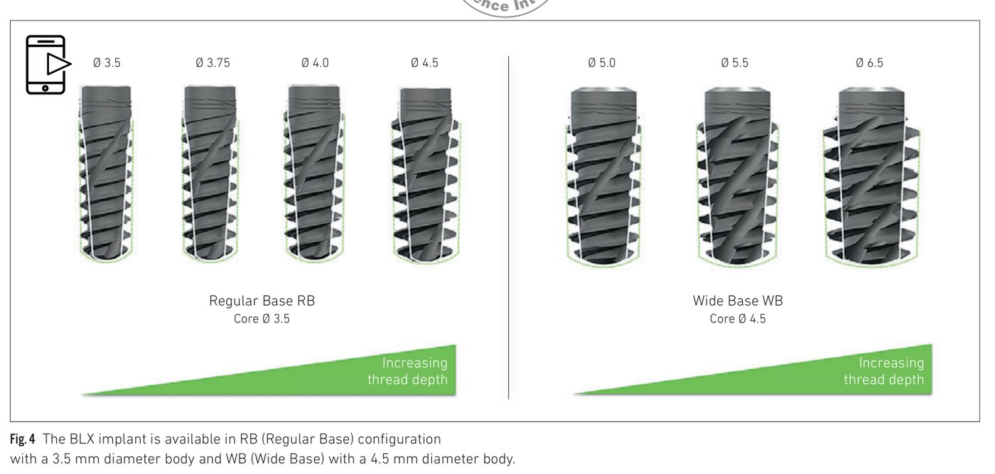 Fig 4: RB and WB implant configurations with thread design variation according to implant length