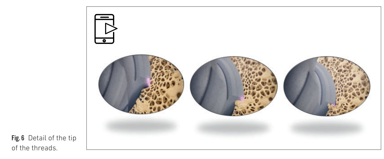 Fig 6: Thread tip detail showing the secant bidirectional cutting geometry