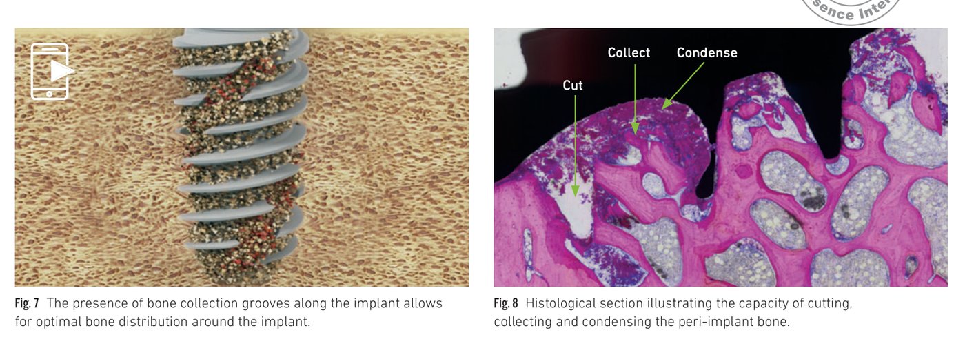 Fig 7-8: Bone collection grooves along the implant and histological cross-section showing bone-to-implant contact