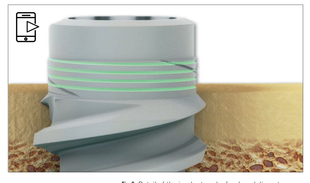 Fig 9: Reduced neck diameter of the BLX implant minimizing cortical stress