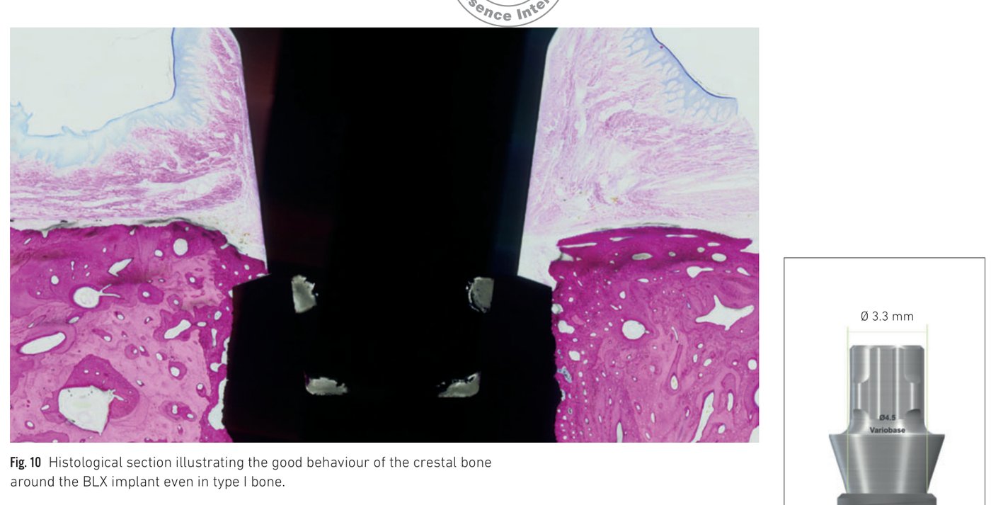Fig 10: Histological section of crestal bone preservation around the BLX implant