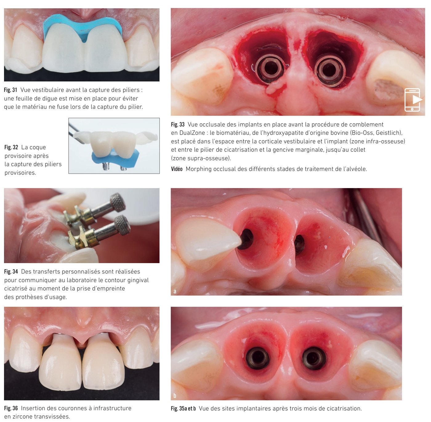 Cas clinique 3 — Protocole TempShell, comblement et prothèses d'usage (Fig. 31 à 36)