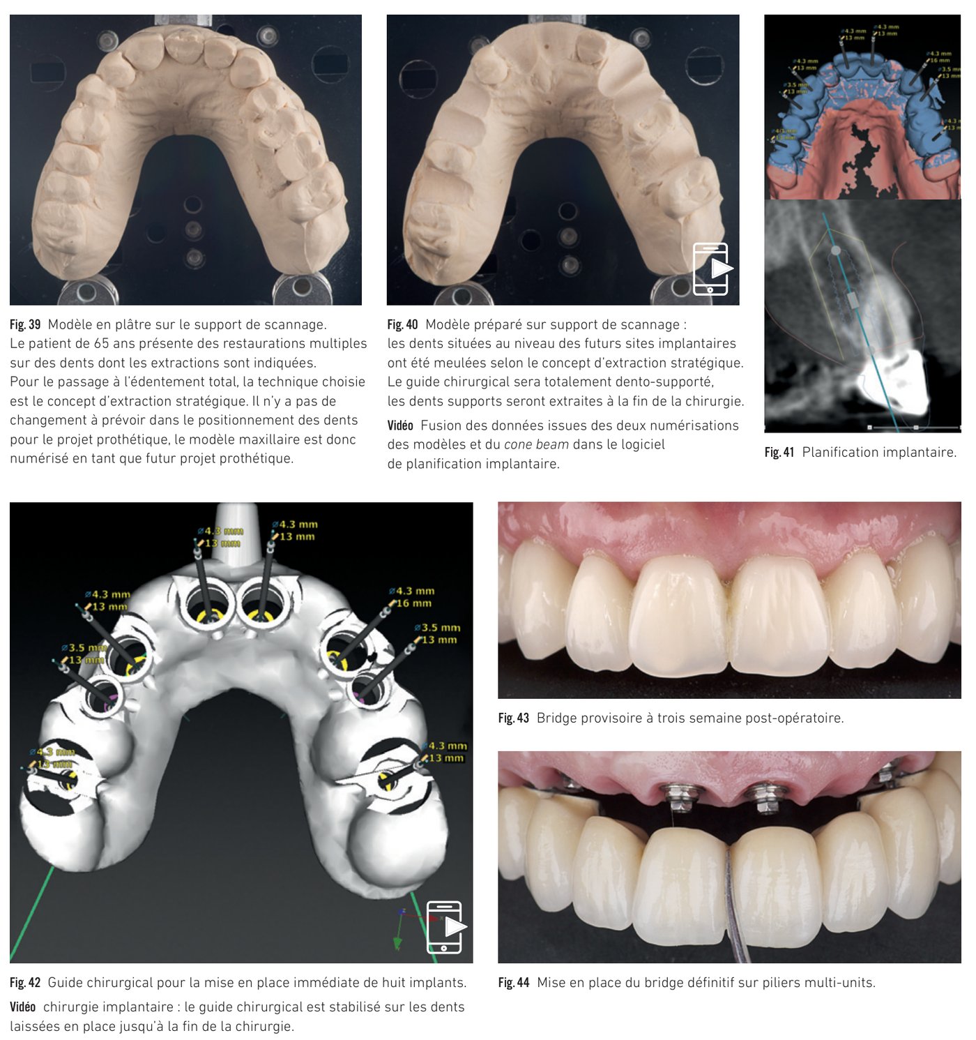 Cas clinique 4 — Extraction stratégique et mise en place de huit implants (Fig. 39 à 44)
