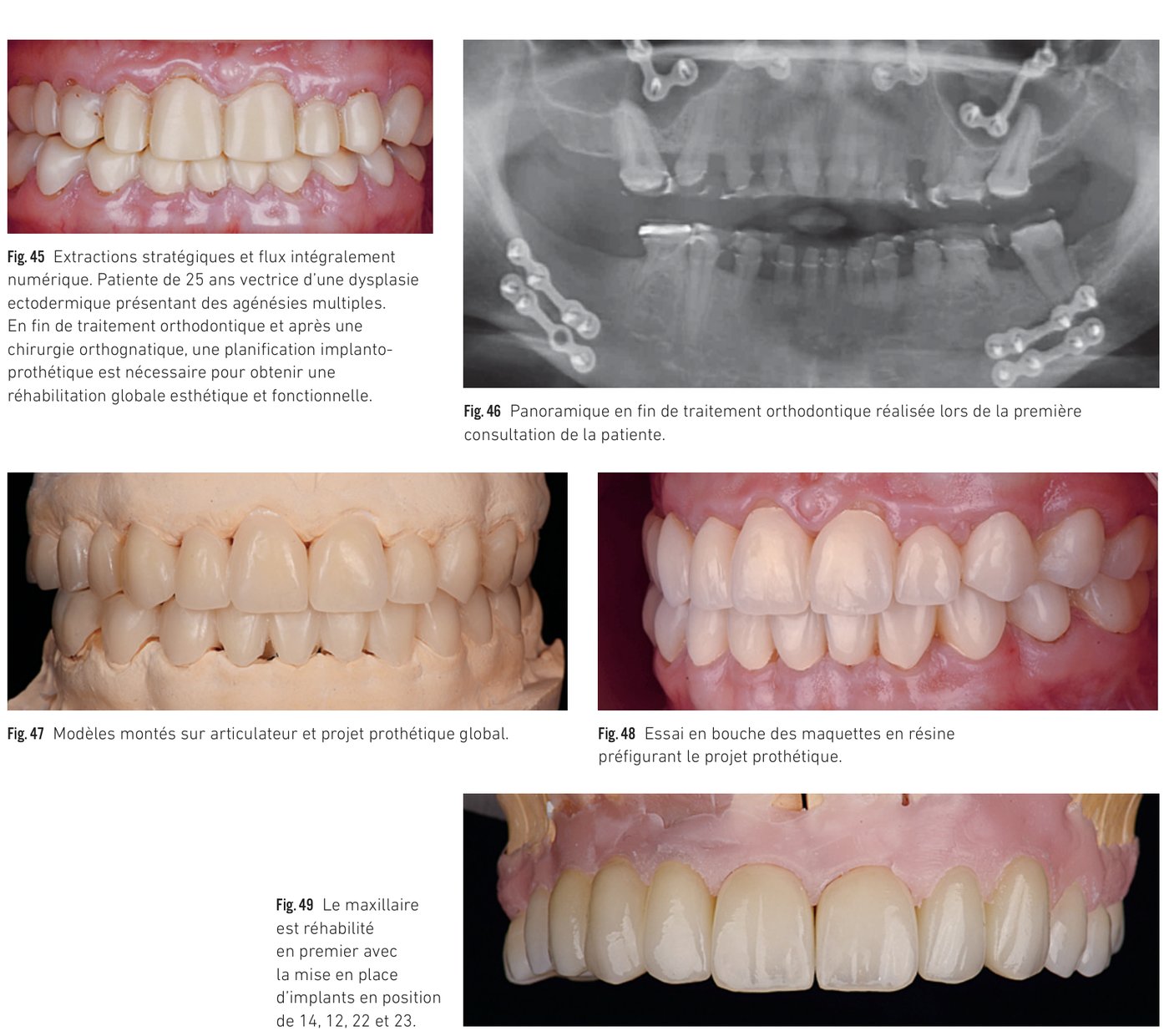 Cas clinique 5 — Dysplasie ectodermique, projet prothétique et réhabilitation maxillaire (Fig. 45 à 49)