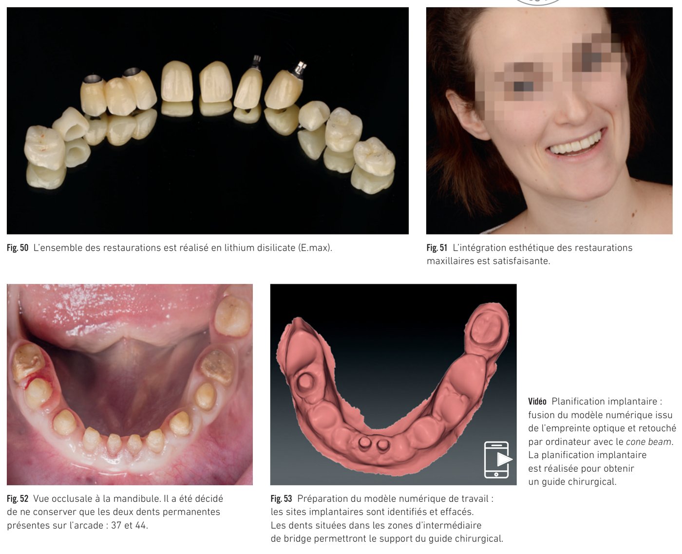 Cas clinique 5 — Restaurations en lithium disilicate et planification mandibulaire (Fig. 50 à 53)