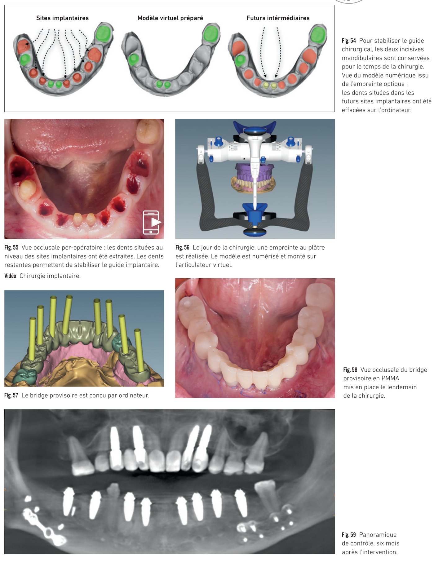 Cas clinique 5 — Chirurgie mandibulaire guidée avec extraction stratégique et bridge provisoire (Fig. 54 à 59)