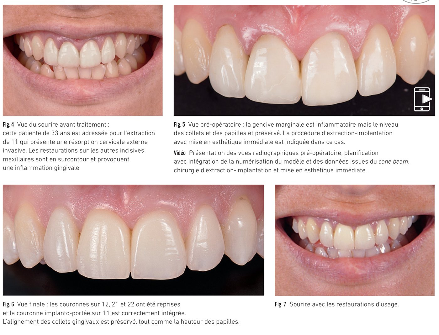 Cas clinique 1 — Numérisation du modèle de travail et mise en esthétique immédiate (Fig. 4 à 7)
