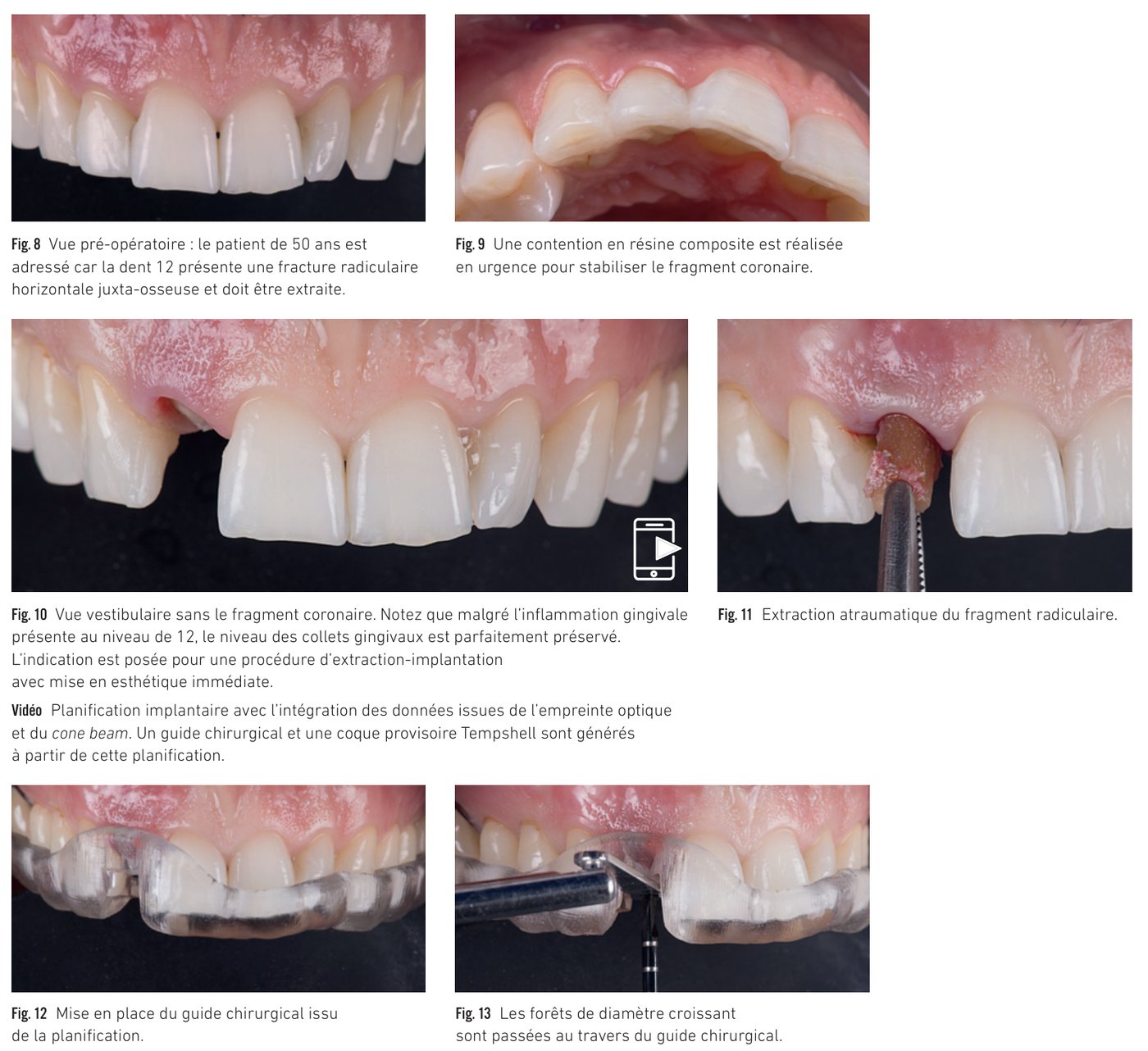 Cas clinique 2 — Vues pré-opératoires et mise en place du guide chirurgical (Fig. 8 à 13)