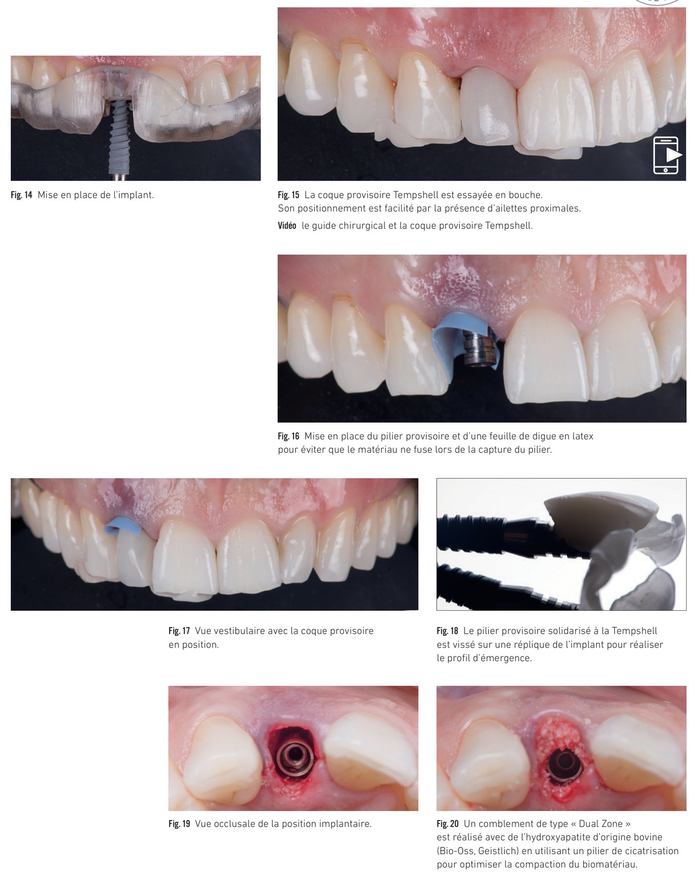 Cas clinique 2 — Mise en place de l'implant, TempShell et comblement Dual Zone (Fig. 14 à 20)