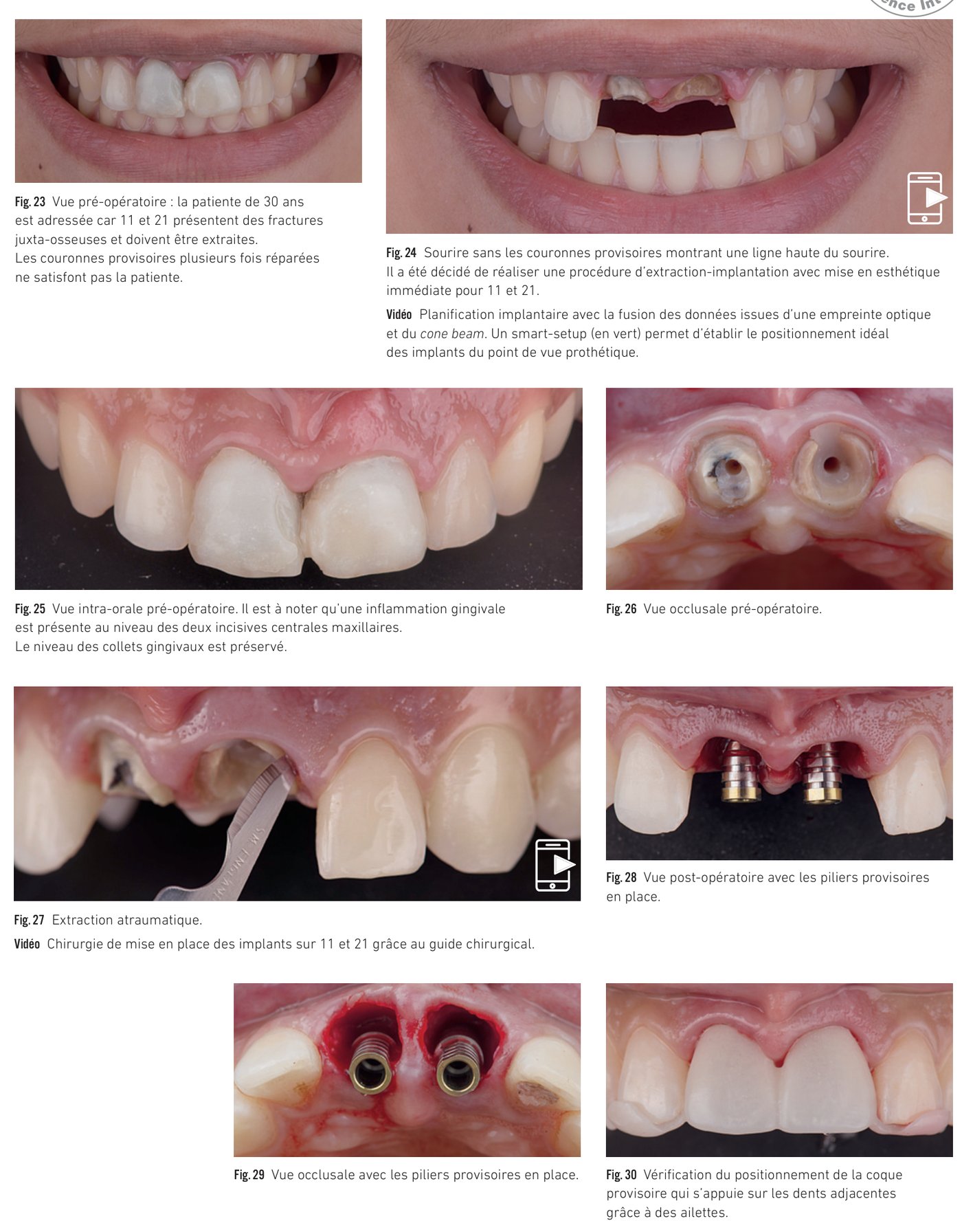 Cas clinique 3 — Vues pré-opératoires et chirurgie guidée bilatérale (Fig. 23 à 30)