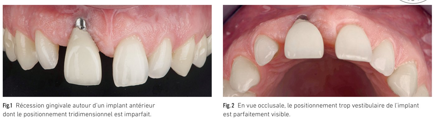 Fig. 1 Récession gingivale autour d'un implant antérieur — Fig. 2 Vue occlusale du positionnement trop vestibulaire