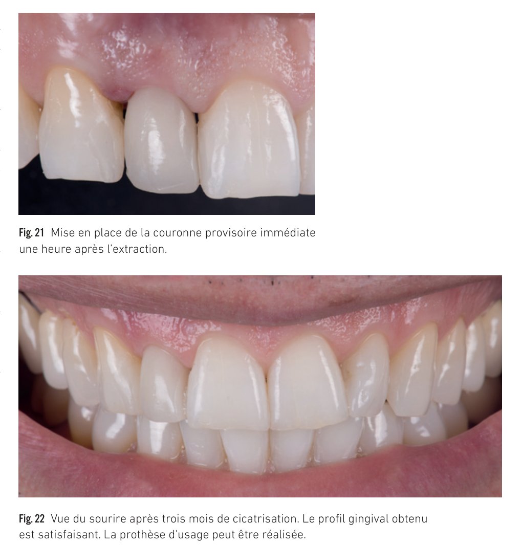 Fig. 21 Couronne provisoire immédiate — Fig. 22 Vue du sourire après trois mois de cicatrisation