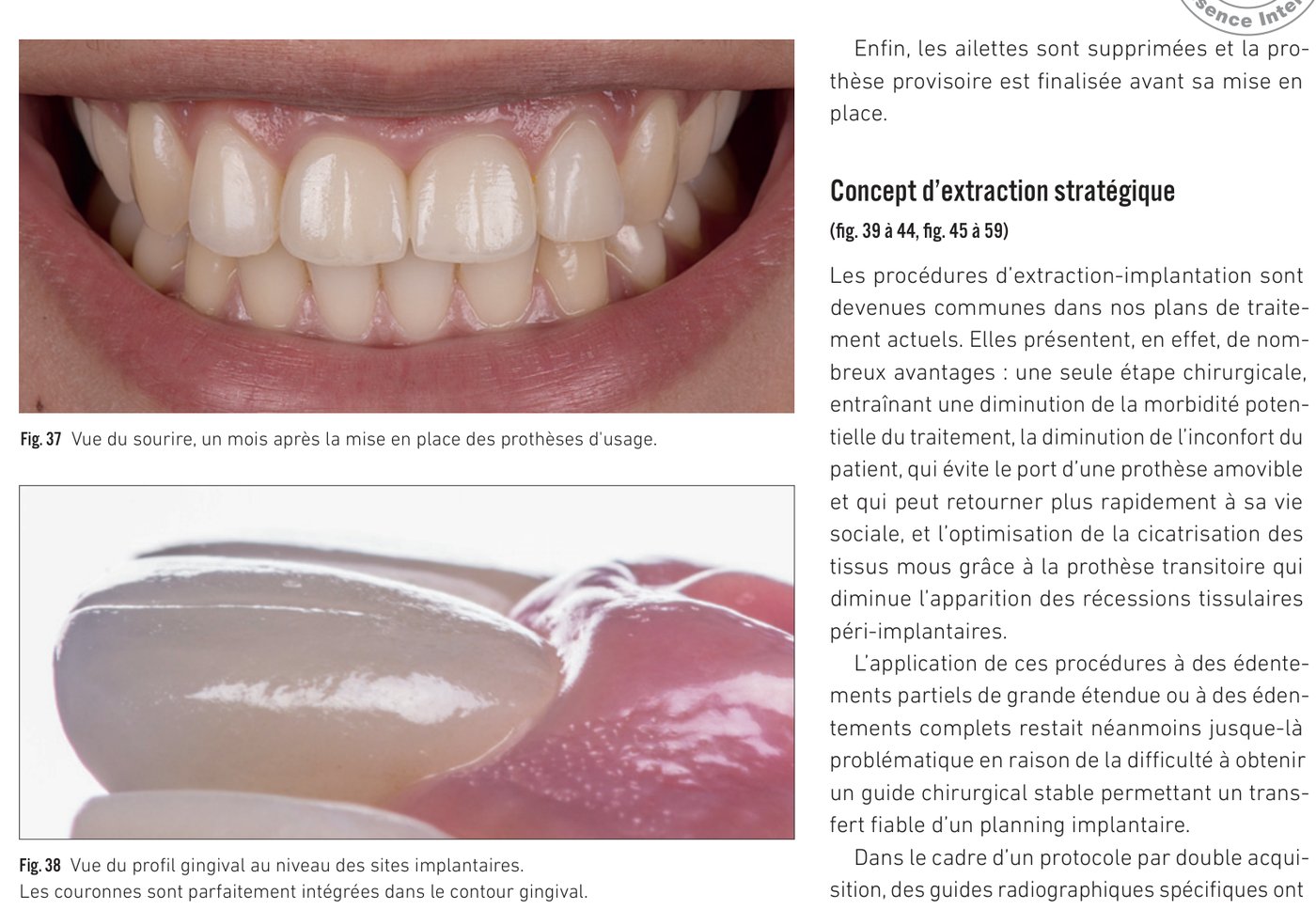 Fig. 37 Vue du sourire avec prothèses d'usage — Fig. 38 Profil gingival au niveau des sites implantaires