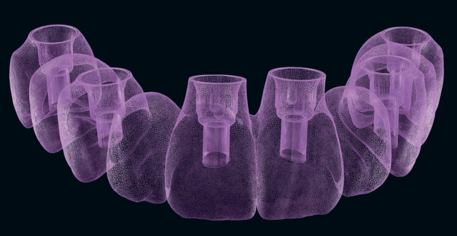 Quelle technique d'empreinte pour un bridge complet sur implant — présentation et résumé