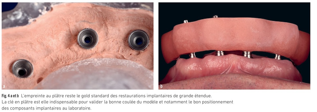 Empreinte au plâtre gold standard — protocole et clé de validation de la coulée du modèle