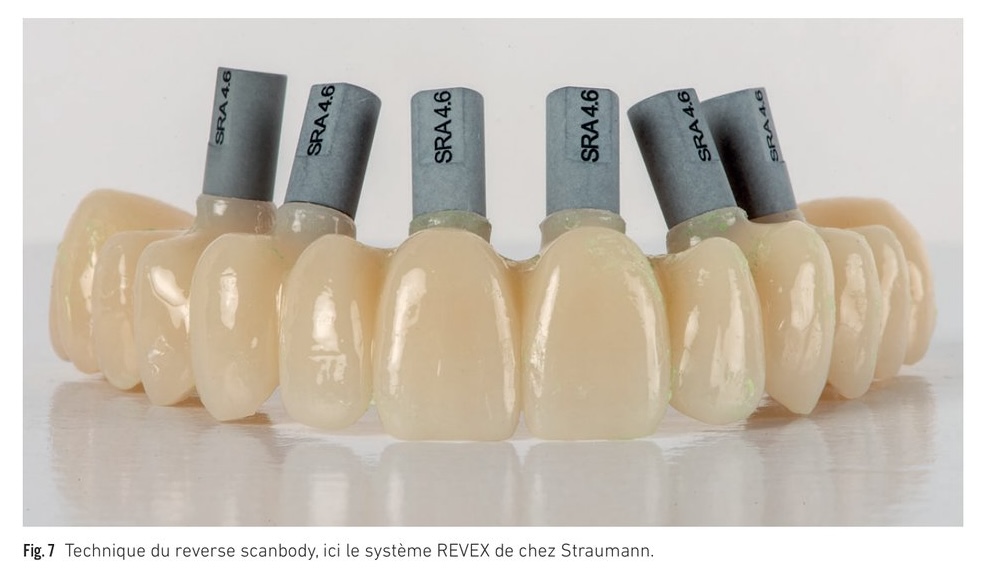 Technique du reverse scanbody (système REVEX Straumann) — dépendance au stitching