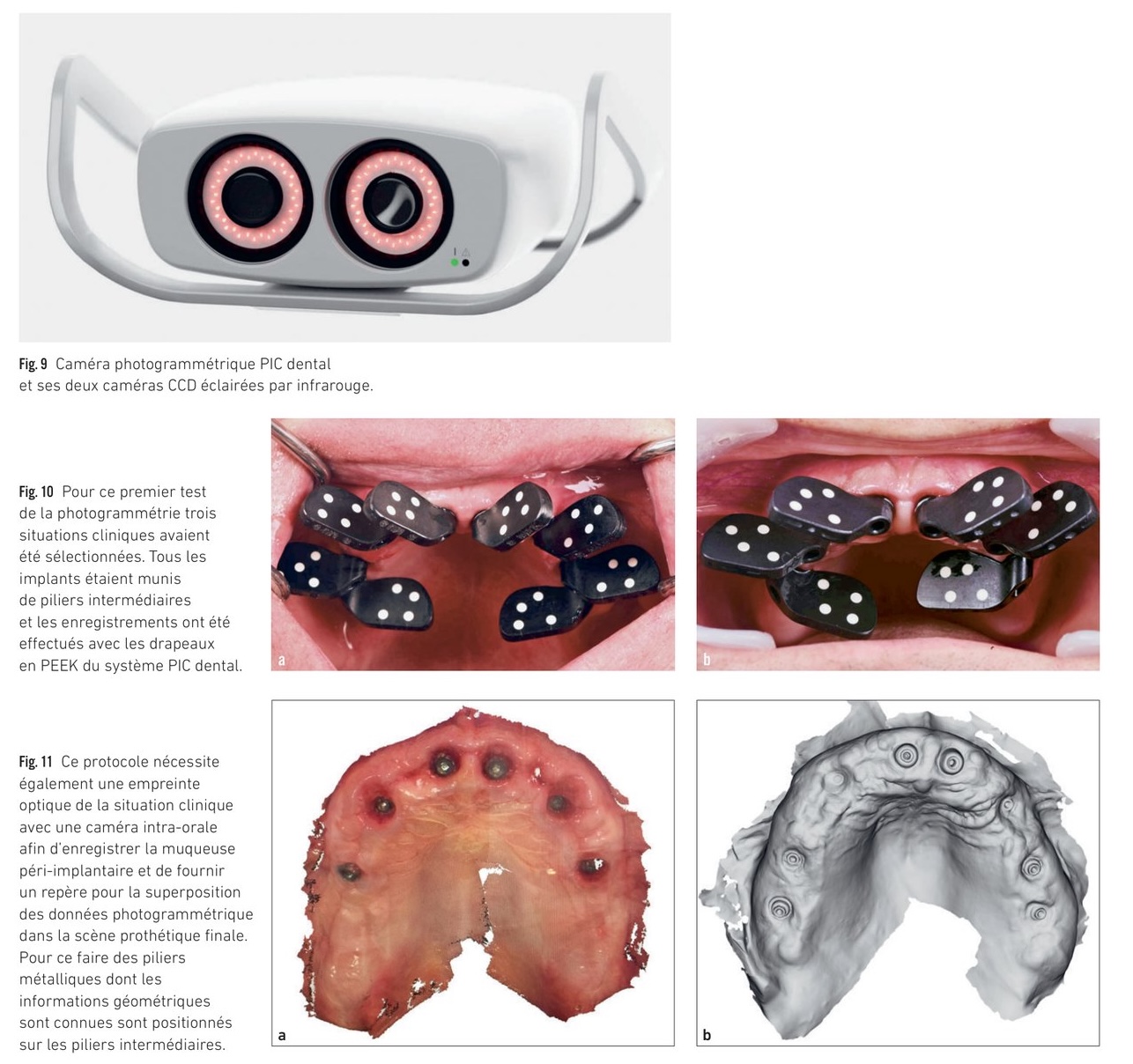 Photogrammétrie PIC dental — premiers tests cliniques comparatifs avec l'empreinte au plâtre