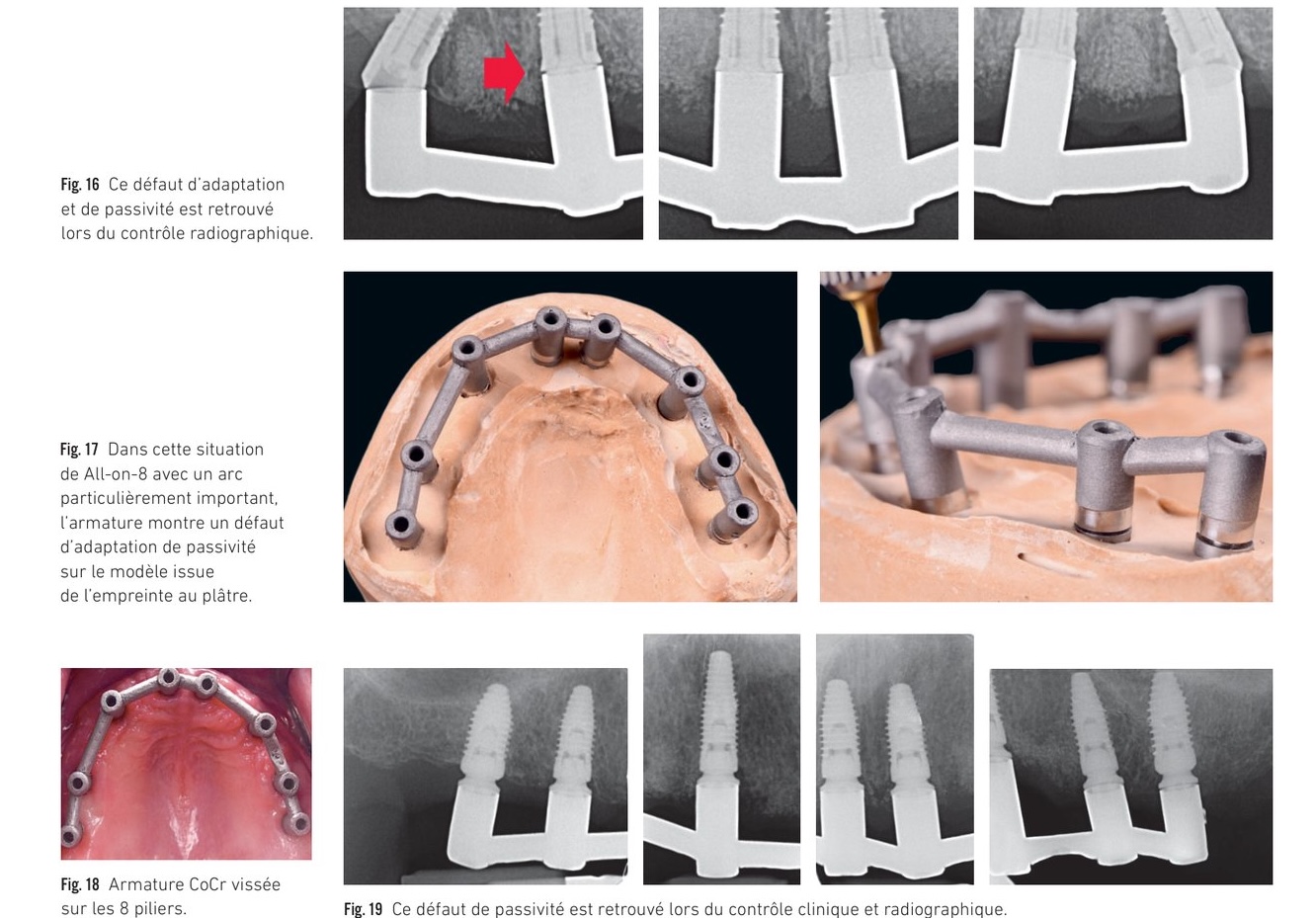 Évolution technologique des scanbodies PMMA vers les systèmes actuels plus précis