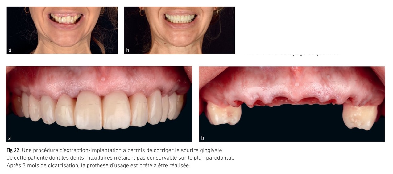 Photogrammétrie intra-orale hybride Shining 3D — acquisition et tests de passivité