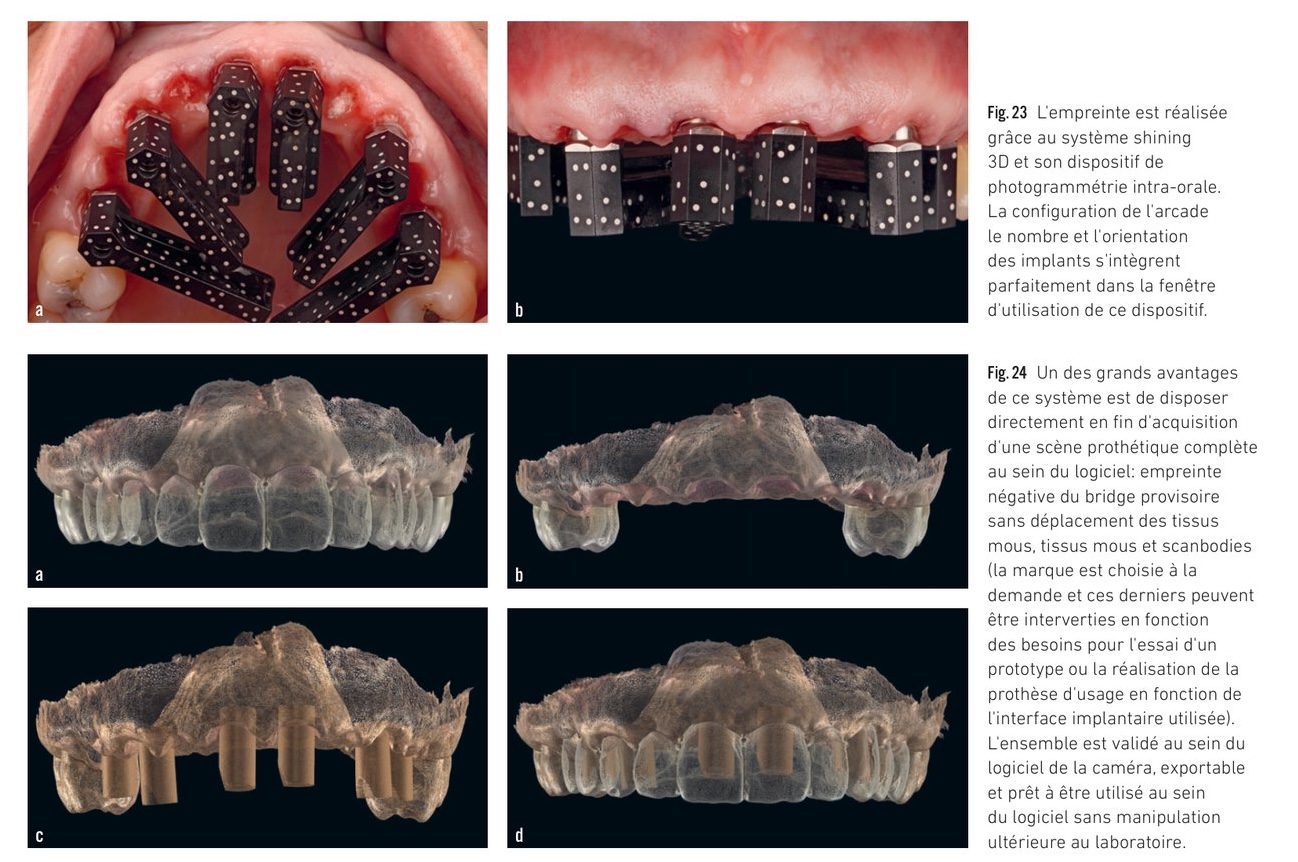 Photogrammétrie intra-orale — scanbodies dédiés et identiﬁcation algorithmique des axes implantaires
