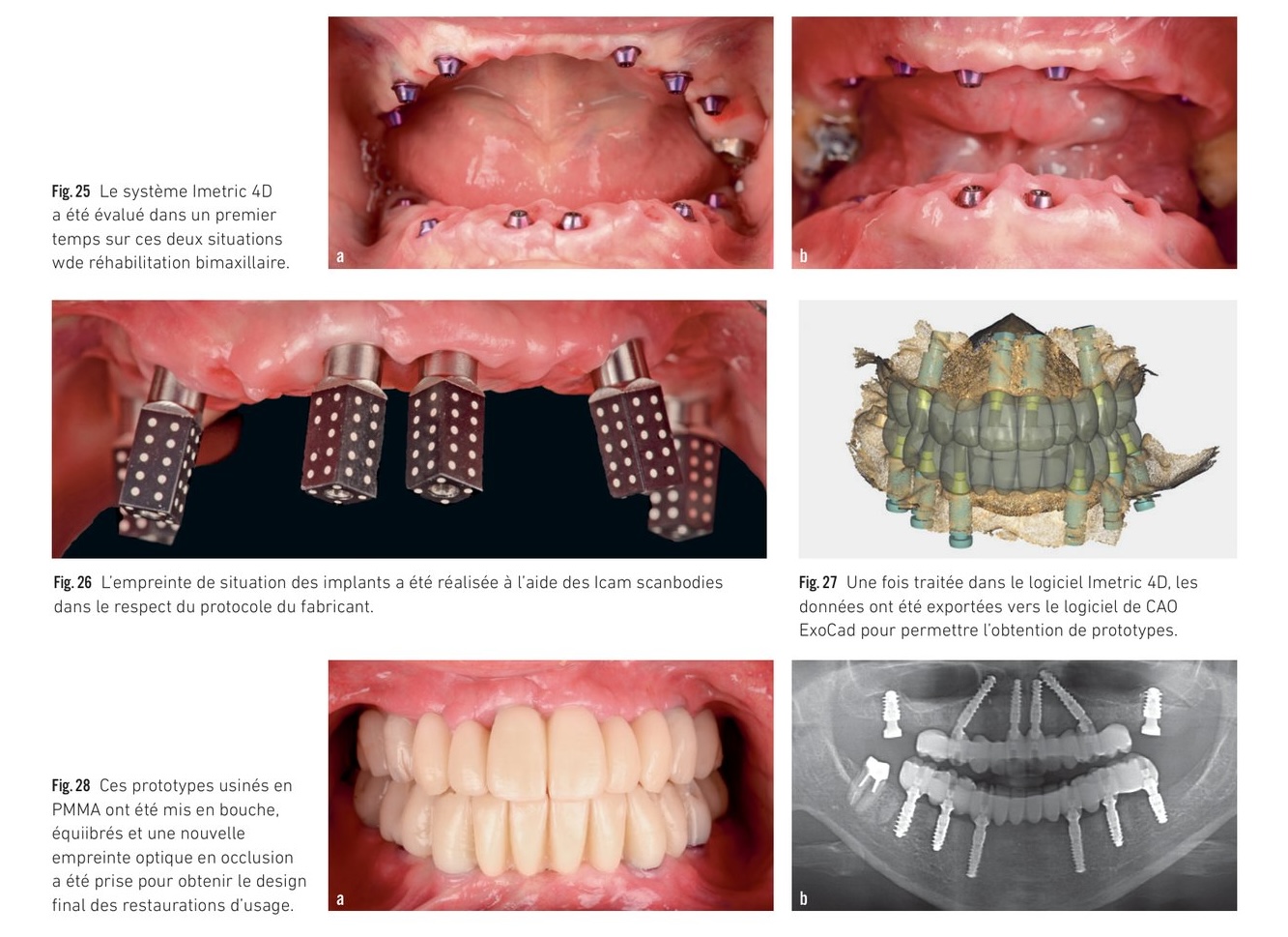 Résultats cliniques — tests de passivité des armatures sur quatre arcades complètes