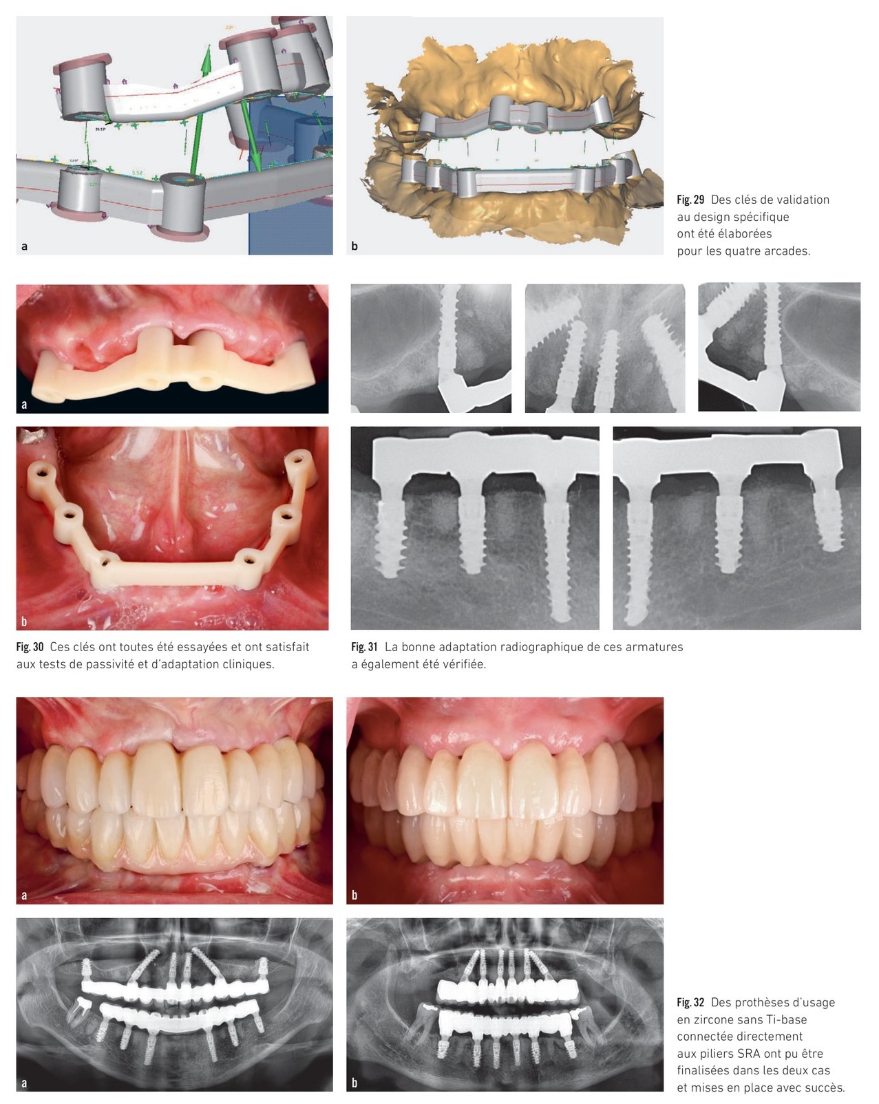 Validation clinique — clés de passivité, radiographies et prothèses zircone définitives
