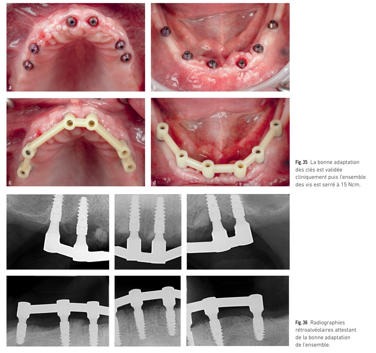 Comparaison des précisions résiduelles entre différentes techniques d'empreinte numériques